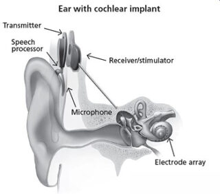 cochlear implant in Gwalior