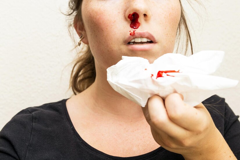 nosebleed woman bleeding